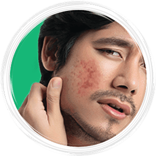 Jerawat New